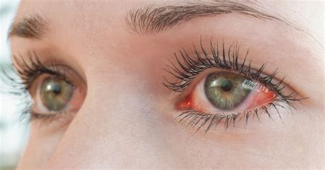 It can also occur from overwearing <strong>contact</strong> lenses or not cleaning them properly. . Eye irritation after removing contacts